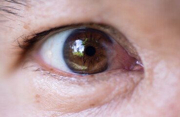 The eyes of people with cataract, a disease of the eye.	