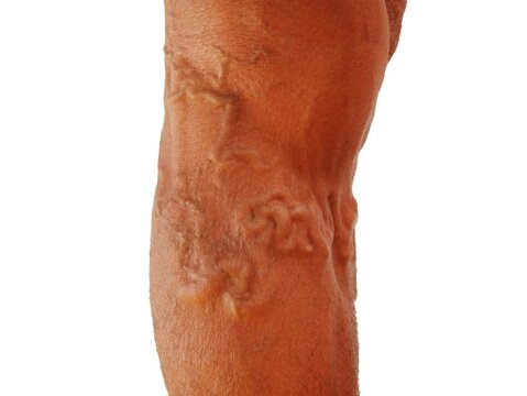 The severity of the varicose veins ranges from the tiny capillaries, pain in the legs, swollen feet and legs, and the crooked aneurysm resembles a worm.