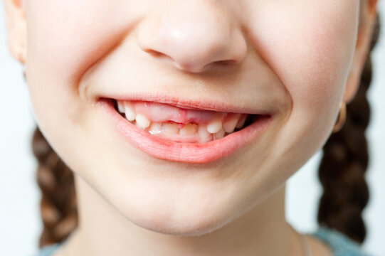 In the child's mouth, two upper front milk teeth were torn out.