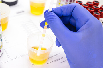 urinalysis with reagent strips to analyze Leukocytes, Urobilinogen, Bilirubin, Blood, Nitrite, pH,...