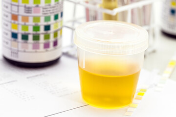 urine bottle, urinalysis to analyze Leukocytes, Urobilinogen, Bilirubin, Blood, Nitrite, pH,...