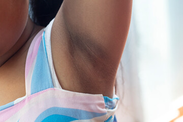 Dark armpit problems in fat children due to hormonal changes and skin friction.