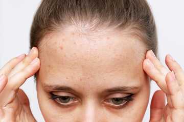 Fototapeta premium Cropped shot of a young woman's face with the problem of acne. Pimples on the forehead. Allergies, red rash to sweat, hormonal changes. Problem skin, care and beauty concept. Dermatology, cosmetology