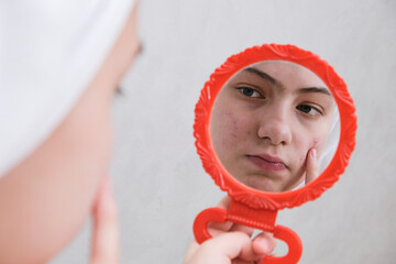 sad teenage girl. Problematic skin in adolescents.