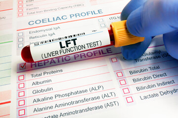 Blood sample over samples requisition form for check of LFT Liver Function Test in laboratory. Blood tube test of patient for Hepatic analysis in hematology laboratory