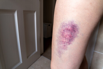 Terrible bruise on the upper leg of a woman