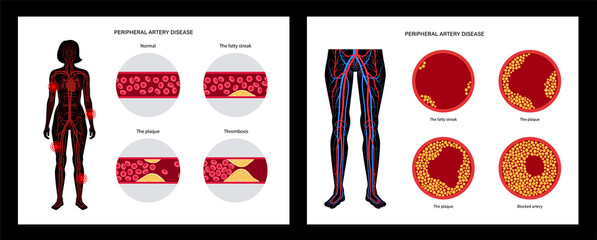 Peripheral artery disease - obrazy, fototapety, plakaty