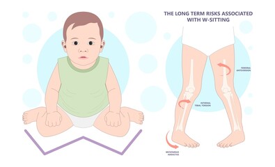Obraz premium injury Birth infant genu valgum varum criss cross and club foot tailor body side W Sitting wrong bad position of bent hip Bow leg knock knees in core kids children baby back pain poor toed walking