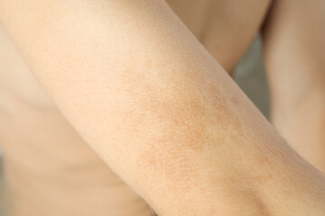 Concept of skin care, hand of young man with brown spots