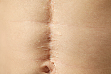 Stomach of young man with scar, close up