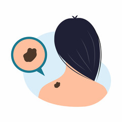 Young woman with birthmark in neck area. World Melanoma Day. Cancerous tumor. Vector illustration on topic of medicine and health problems. - obrazy, fototapety, plakaty