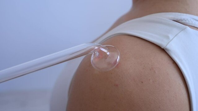 The doctor uses the darsonval apparatus against acne on the shoulder of a female patient.