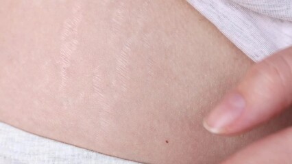 Stretch marks on the body of an overweight woman after pregnancy. Damaged skin of a girl close-up, front view.