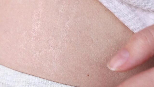 Stretch marks on the body of an overweight woman after pregnancy. Damaged skin of a girl close-up, front view.