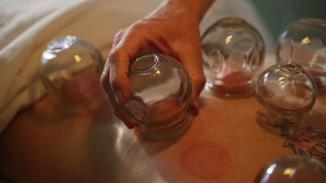 Therapist Applying Cupping Suction Cups to Patients Back. HD Slow Motion.