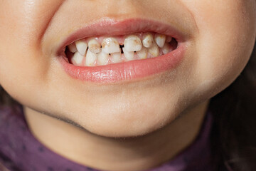 The child shows teeth with hypoplasia. Pediatric dentistry and periodontology, bite correction....