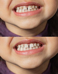 The child shows milk teeth with stains and plaque close-up. Two photos before and after. Children's...