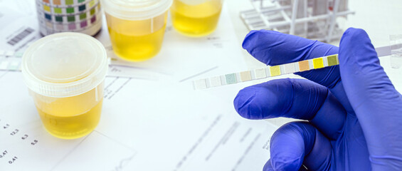 urine test, made with a vial of Urinalysis Reagent Strip used for ketosis control, laboratory examination.
