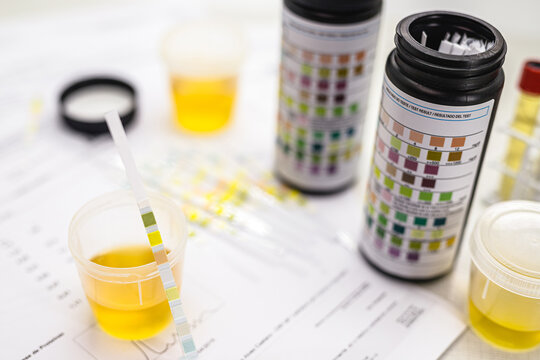 full urine bottle with reagent strip used in urinalysis, bottle with parameters on the side