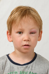 Portrait of a boy with a swollen eye from an insect bite. Allergic reaction to insect bites. the red sick eye of a teenage boy. vertical frame