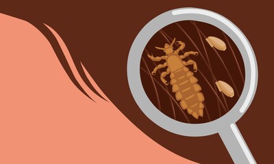 Vector illustration, head lice or Pediculus humanus capitis with eggs stuck to hair.