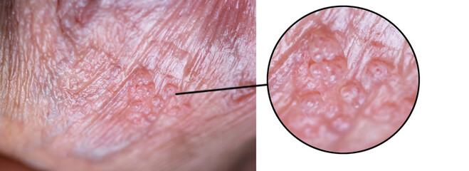 Macro photo of human hpv papillomavirus, man with skin lesion by virus