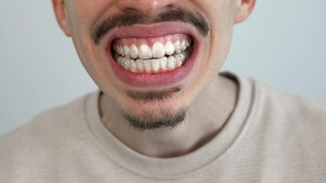 Adult man putting transparent braces for dental correction. Caucasian person holding invisible orthodontic retainer and aligner. Plastic braces dentistry to straighten teeth in dentist office