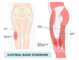 Thigh treat athlete tear sprain muscle inflammatory runner cycling hiking shot knee hip pain sport IT band Pes bursa tract medial soccer tibia femoris RICE Rest ice elevation method strain