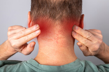 Fototapeta premium Nape pain closeup. Ache in back neck. Man suffering from injury, strain.