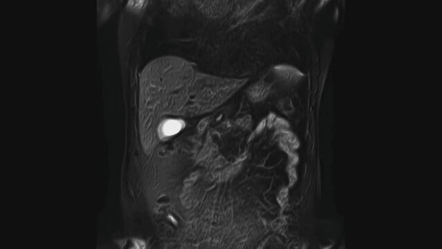 Voluminous CT scan of the abdomen. Computed tomography of the gastrointestinal tract, liver and kidneys