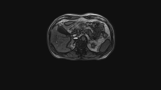 Voluminous CT scan of the abdomen. Computed tomography of the gastrointestinal tract, liver and kidneys