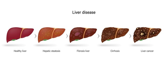 Liver disease. Stages of liver damage. Healthy liver, hepatic steatosis , fibrosis, cirrhosis and liver cancer.