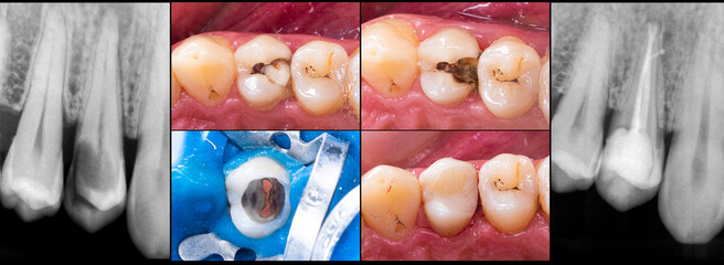 root canal treatment for upper first premolar