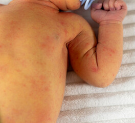 yellowish neonatal jaundice of the skin occurs in newborns in the first days of birth
