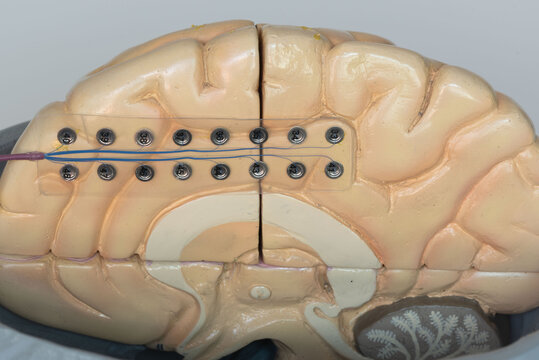Subdural electrode on medial side of brain hemisphere