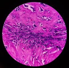 Finger (biopsy): Giant cells tumor,  Microscopic view a neoplasm of numerous osteoclast like giant...