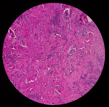 Finger (biopsy): Giant cells tumor,  Microscopic view a neoplasm of numerous osteoclast like giant cells on the background round to oval mononuclear cells.