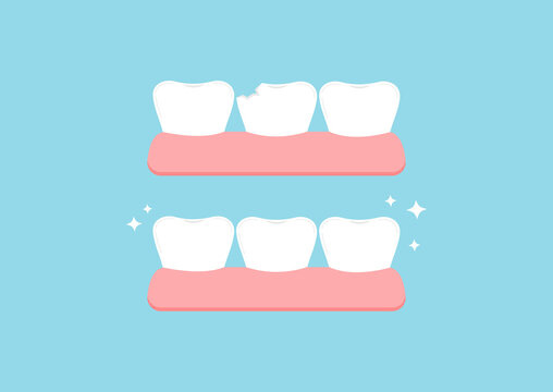 Injury chipped tooth and healthy tooth before, after treatment icon set. Broken teeth with problem treatment concept. Flat cartoon style vector illustration.