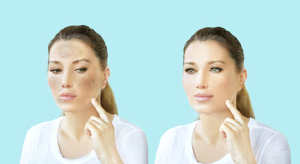 Dark spots, freckles,hyperpigmentation(melasma or chloasma),concept - skin lightening, skin whitening, fruit acids,AHA, Skin Brightening.