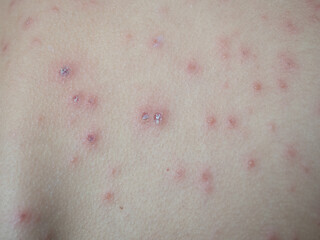 Treatment of ulcers from chickenpox, varicella with medical cream on the kid skin