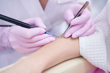 Dermatologist cauterizing nevus with heated tip of electrocautery unit