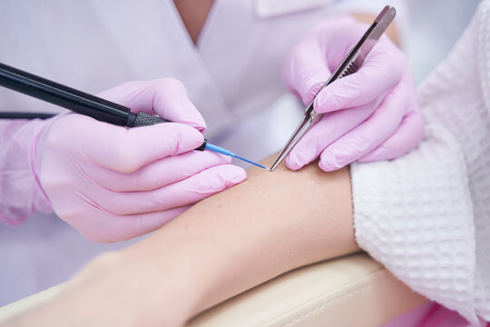 Dermatologist cauterizing nevus with heated tip of electrocautery unit