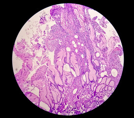 Close microscopic view of stomach tissue biopsy showing Adenomatous polyps. Stomach polyps, Gastric Polyps.