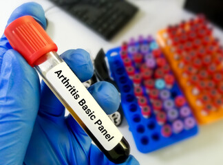 Blood sample for arthritis panel test.