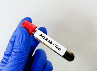 Test tube with blood for AChR or Acetylcholine receptor antibody test, diagnosis of myasthenia...