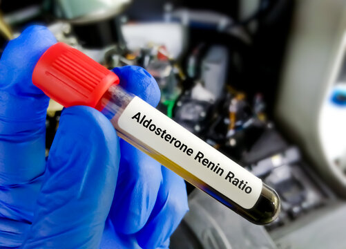 Blood sample for aldosterone renin ratio.