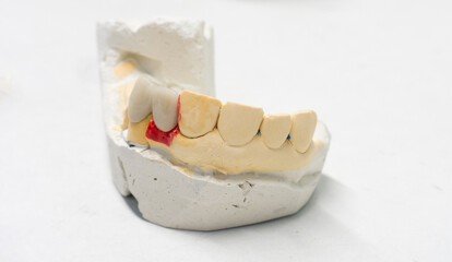 Teeth from ceramics