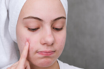 teenage girl points her finger at the pimples on face.