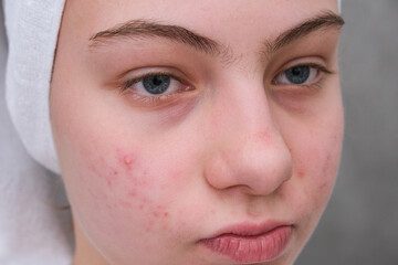 teenage girl twisted her facewith acne.