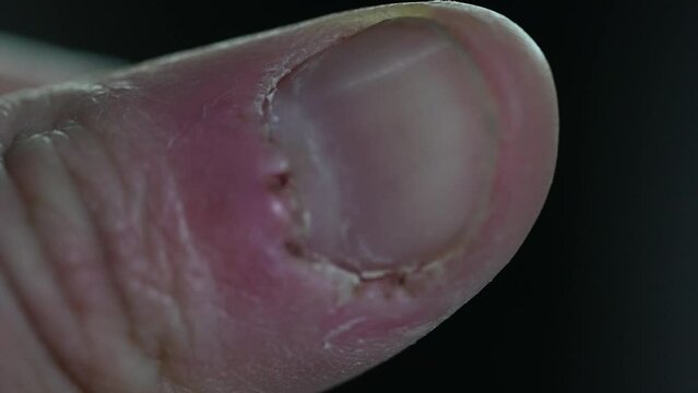 bitting nails finger. anxiety, worry and nervous concept. bad habit